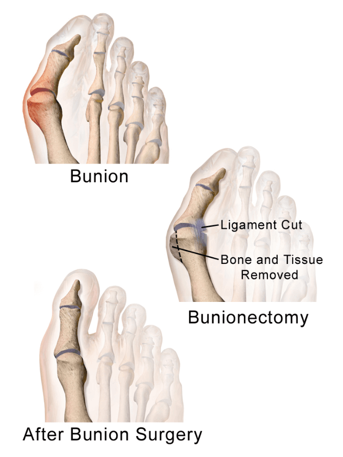 best shoes for bunions